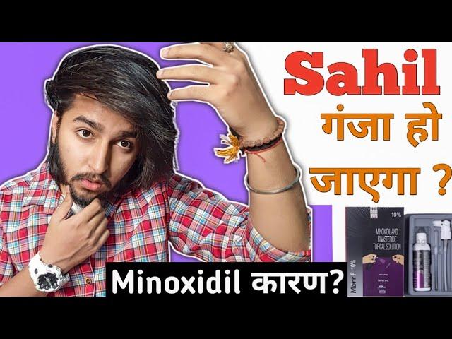 Will I Go Bald Because Of Minoxidil ? | Sahil Nagpal