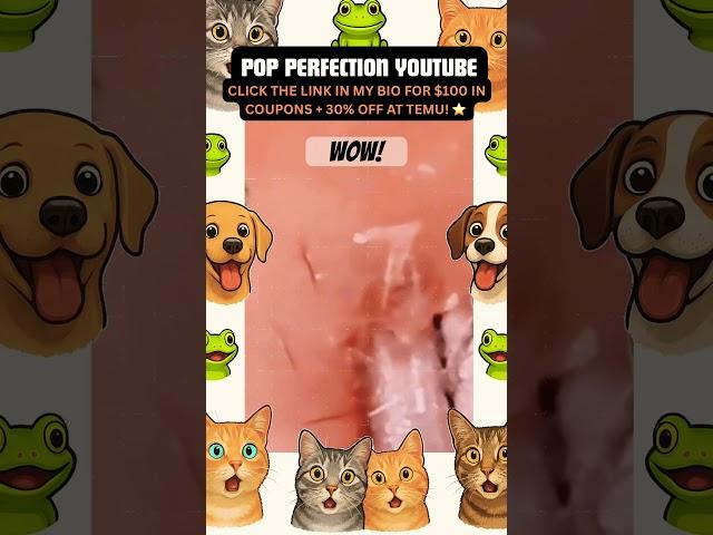 Wow! #youtubeshorts #youtube #shortsfeed #shortvideo #shorts #short #pimple #pimplepopping #pimples