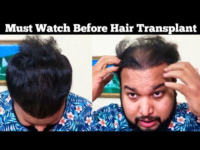 Reality Of Hair Transplant After 3 Years || Best Hair Transplant 2021 || Sourav Mridha