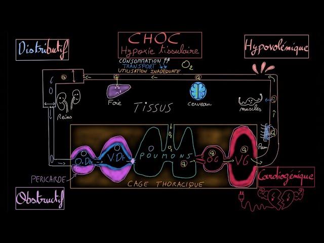 Choc - Cardiogénique - Hypovolémique - Distributif - Obstructif - Docteur Synapse