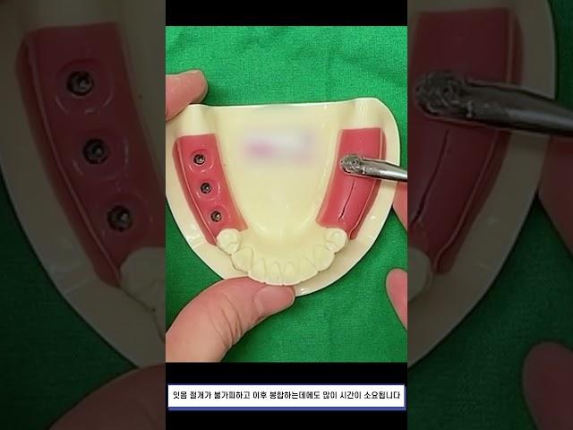 디오나비가 뭐예요? #dionavi #치아건강 #dioimplant