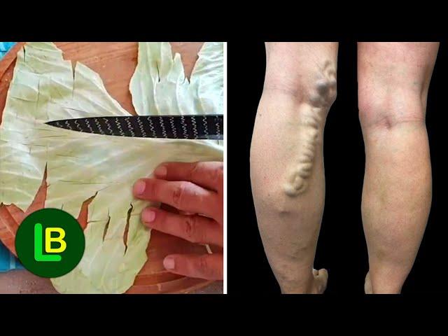 Amazing! Get rid of varicose veins. Just put these leaves over and wait