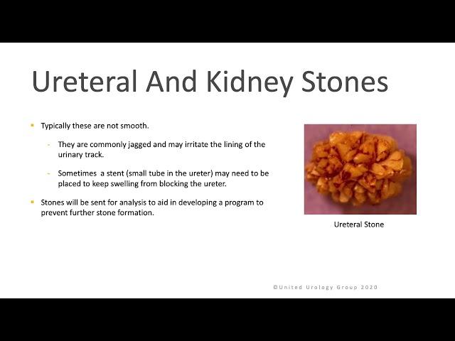 Ureteroscopy for Ureteral and Kidney Stones