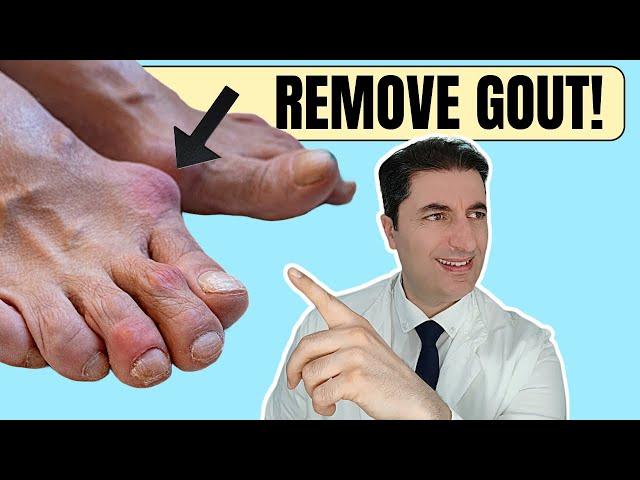 Say GOODBYE to Kidney Stones and GOUT With This Simple Tea!