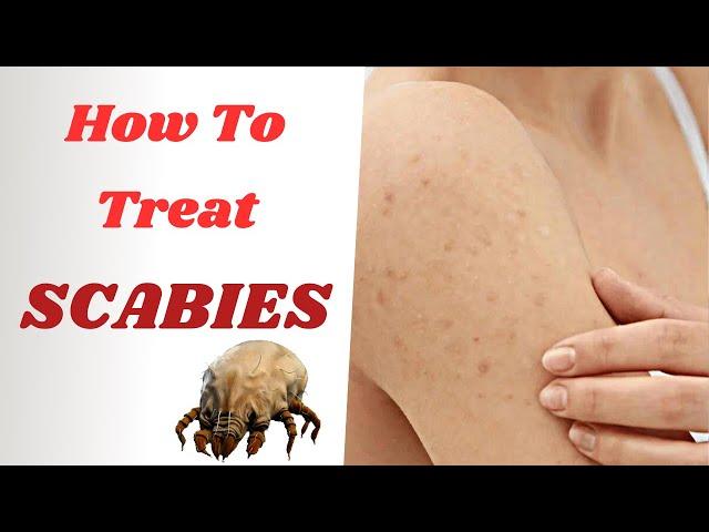 How To Treat Scabies Effectively | From PERMETHRIN Cream To IVERMECTIN Tablets