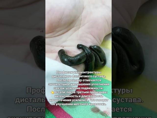 Профилактика контрактуры с помощью пиявок!