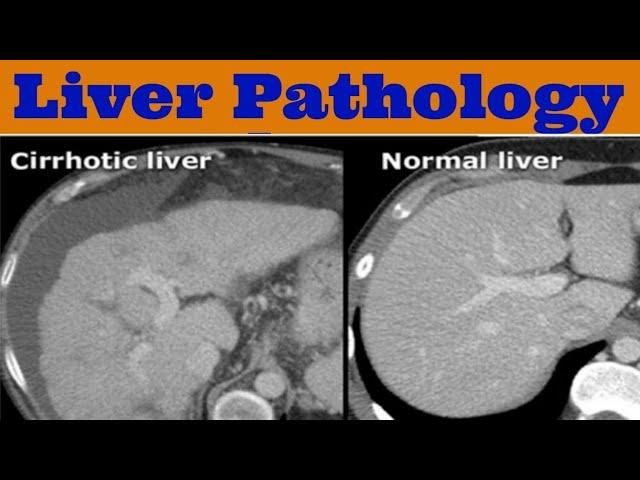 Abdomen Pathology