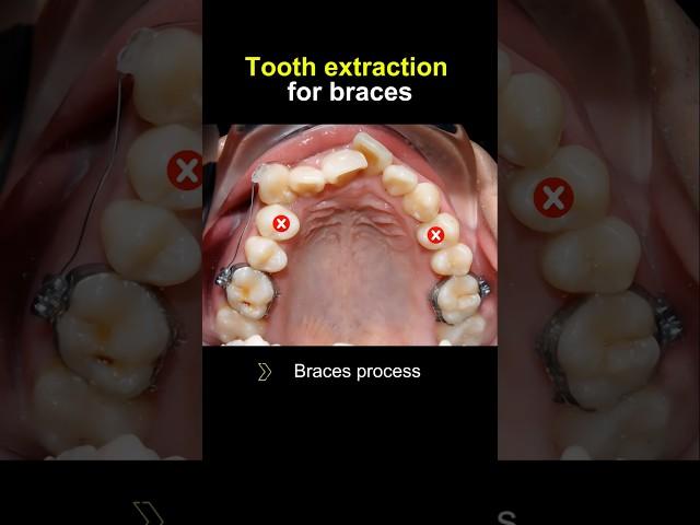 How to fix crooked teeth #braces #orthodontist #dentist #dentistry