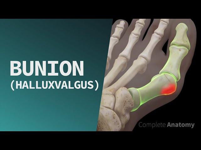 Bunion (Hallux Valgus)