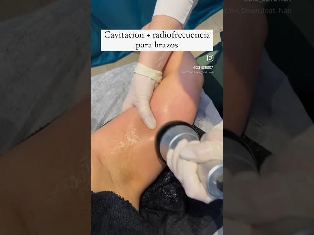Cavitacion y radiofrecuencia para brazos