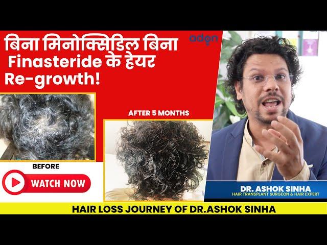 Hair Regrowth Without Minoxidil & Finasteride |Natural Hair Growth | Hair Loss | Hair Fall | Adon |