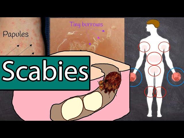 Scabies Symptoms and Treatment