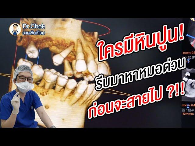 ใครกลัวการทำฟันต้องดู!! ก่อนจะสายเกินไป ?!! | คลายปัญหารากฟันเทียมกับหมอโชค