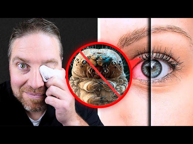 Best Eyelid Wipes To Get Rid Of Eyelid Mites!