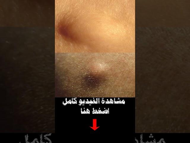 هل الكيس الدهني خطير؟