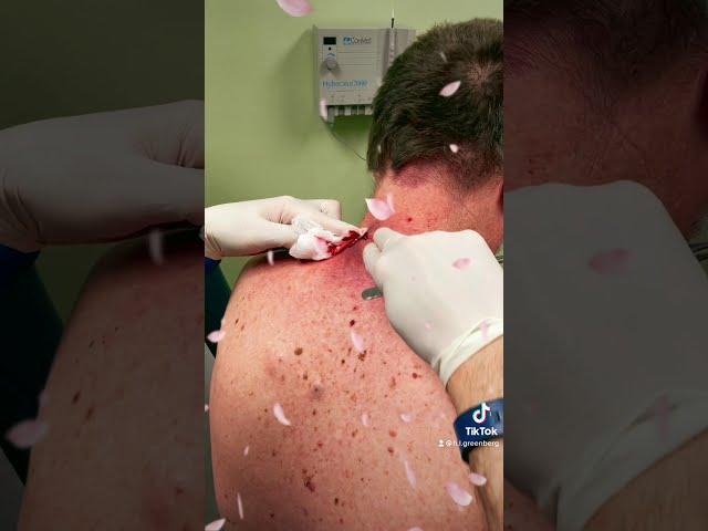 Dr. Greenberg Cyst Follow up video  with Las Vegas Dermatology® incision & drainage procedure  