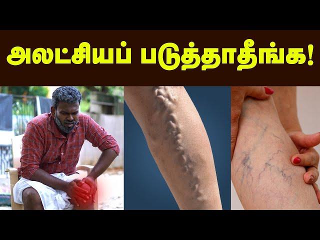 Varicose Vein: ரொம்ப நேரம் நிப்பீங்களா? - Position-அ இப்டி மாத்துங்க! Health tips | Doctor Tamil