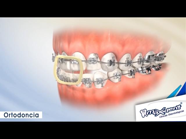 Corrección de mordida y espacios dentales "Ortodoncia"