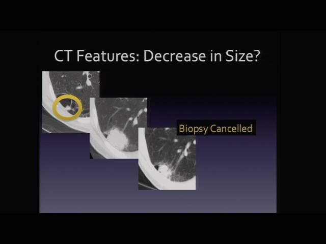 Thoracic Imaging:  Pulmonary Nodule – David Naeger, MD