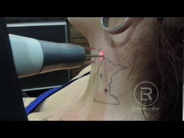 MN Outline Neck Session 3 Laser Tattoo Removal