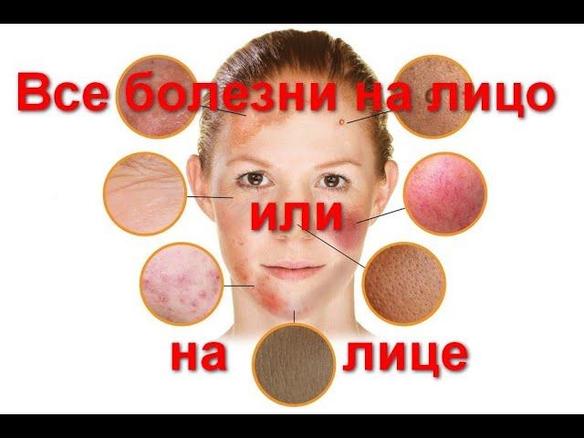Все болезни на лицо или о признаках на лице,  которые свидетельствуют о проблемах со здоровьем.