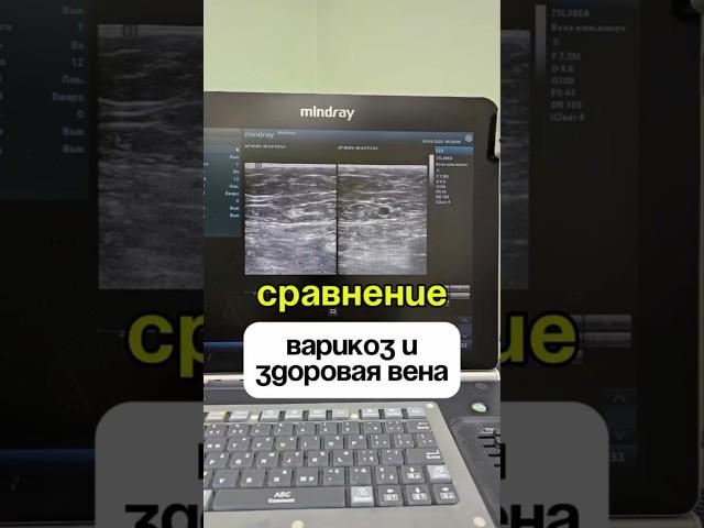 @flebolog делаю так, чтобы ваши ножки были здоровы от варикоза️#флеболог