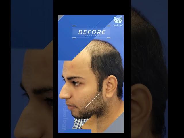 MedLinks Hair Transplant Results | Before After Results #shortsfeed #shorts #medlinks