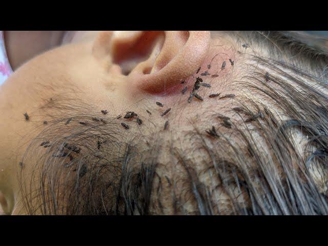 Remove thousand lice from brown hair - Getting out all hundred lice from hair