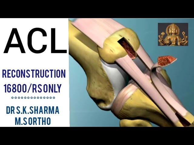 Arthroscopic / OPEN   repair  of A C L  Ligament @suryadrsksharma8008