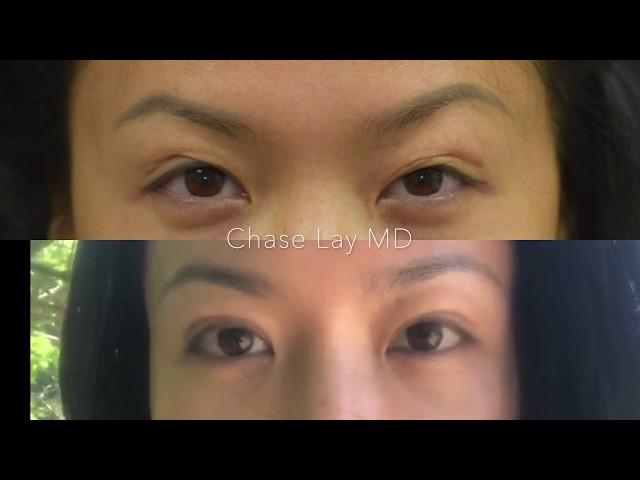 #ChaseLayMD Asian Eyelid Surgery: 7 Time Revision