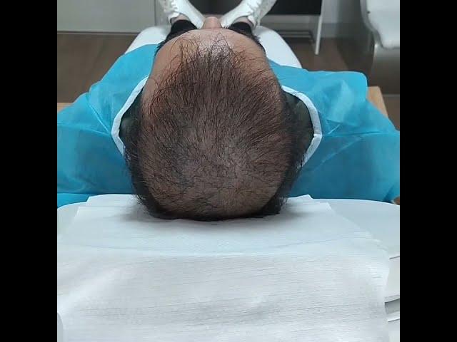 Feyyaz YAVUZ Saç Simülasyonu (Scalp Aesthetic Center)