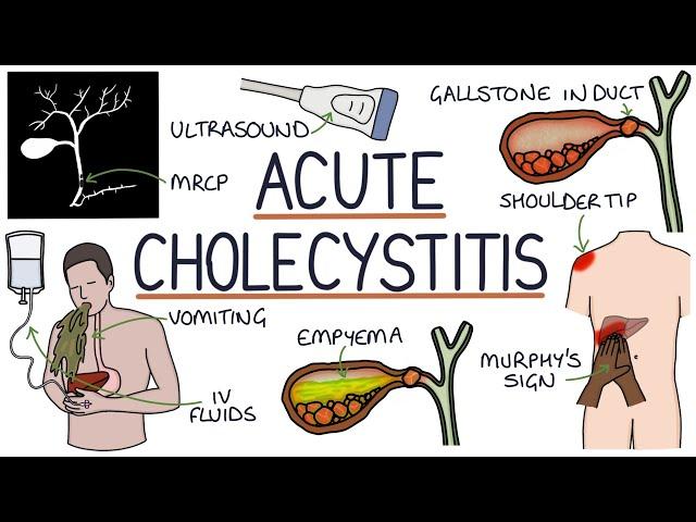 Understanding Acute Cholecystitis