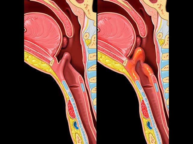 Epiglottitis