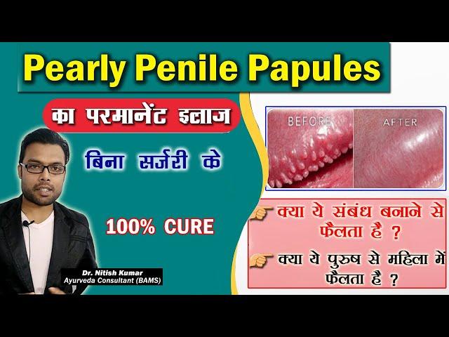 Pearly Penile Papules का इलाज-बिना सर्जरी के | Pearly Penile Papules treatment in Hindi | Dr. Nitish