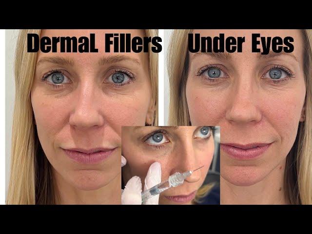 Dermal Filler Under Eyes Restylane