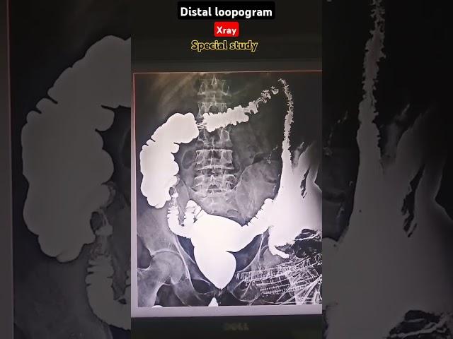 Distal loopogram procedure #medicaltest #medicalimaging #xrayprocedures #radiography #xray#shorts