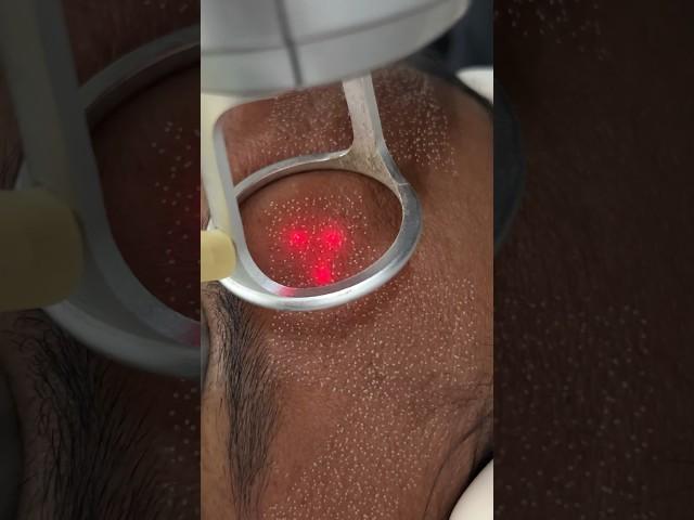 This is how Fractional CO2 laser treatment looks like| laser resurfacing #laserskinrejuvenation