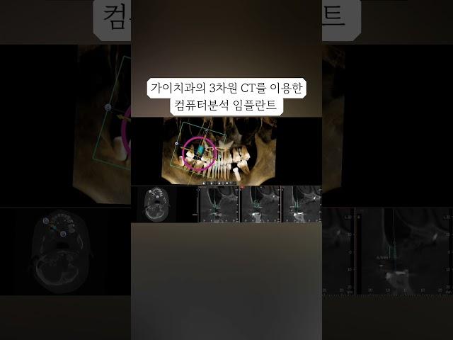 #치아교정. 치아교정으로 임플란트 갯수 줄여볼까요? (신도림역 가이치과 02 886 2877) #치아교정 #치아교정치과 #양심치과 #임플란트대체교정 #부천교정치과