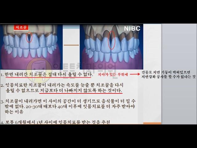 1-12. 치아수명 삼각대 (광안리 뉴욕치과)