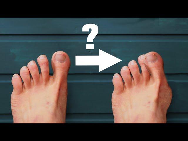 Hallux Valgus - The REAL CAUSE