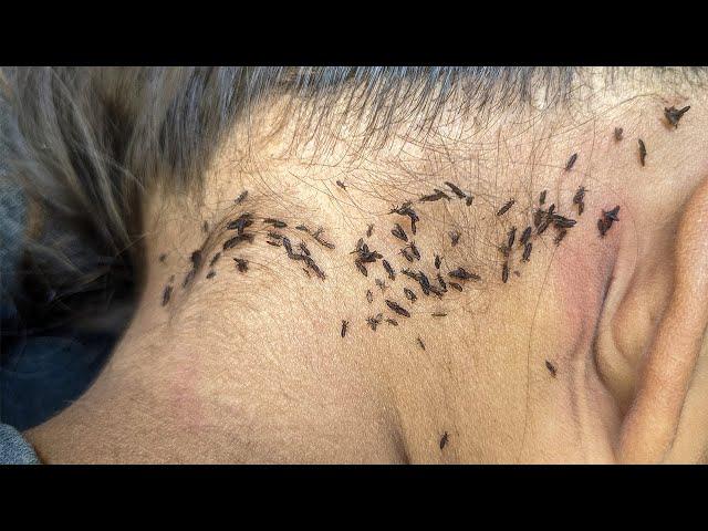 Remove hundred lice from black hair - Pick out all thousand lice from her long hair