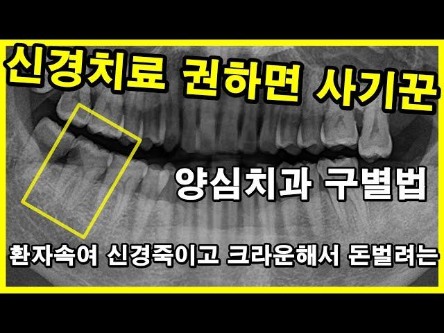 신경치료 권하면 사기꾼. 양심치과 구별법. #신경치료07강 :! 깊은 충치여도 생각보다 신경치료안해도 될 경우 많음. 7번치아충치. 사랑니충치 2022_07_31