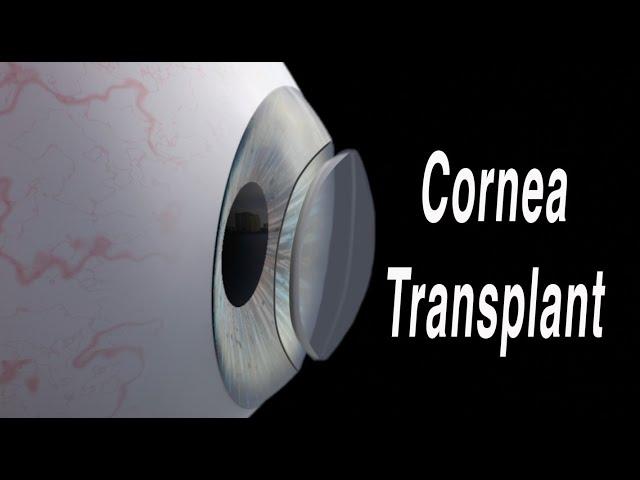 Cornea Transplant (Penetrating Keratoplasty)