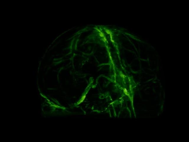A Brain Drainage System