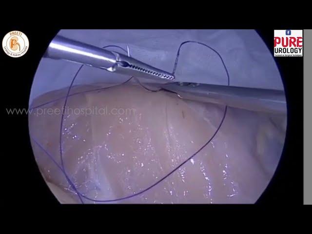 Laparoscopic  suturing : Quick learning in Five minutes