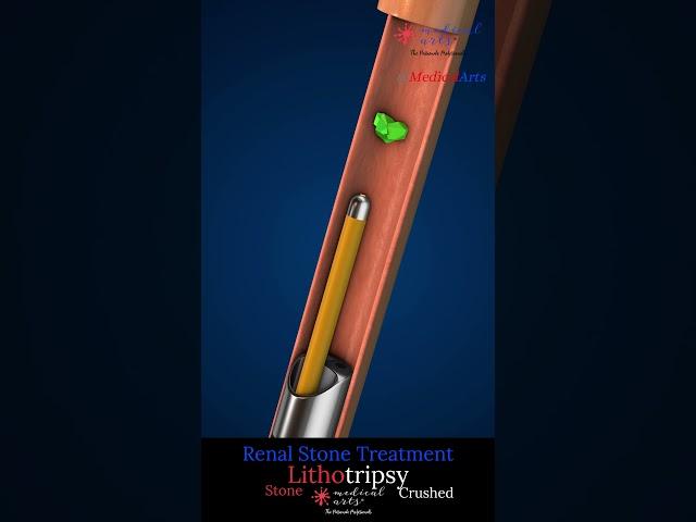 How Doctors Remove Kidney Stones Without Surgery! (Lithotripsy demonstrated)