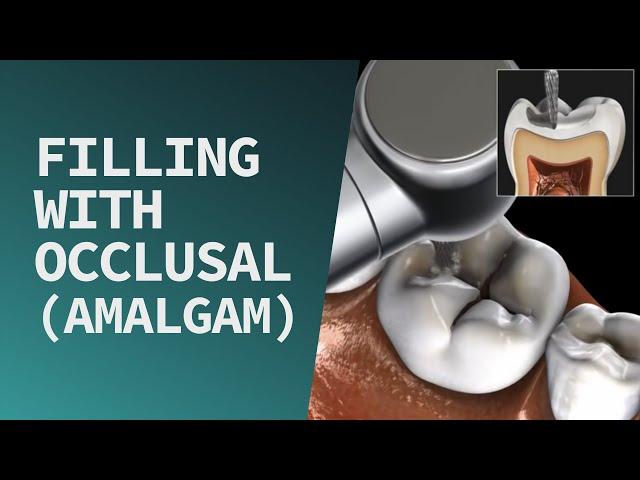 Filling with Occlusal (Amalgam)