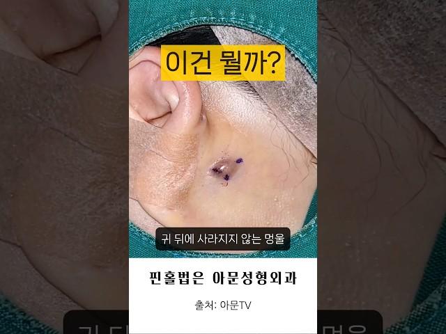 귀뒤 멍울? (뾰루지 피지 압출 핀홀법 피지낭종 표피낭종 수술 여드름 병원 epidermal cyst pimple surgery hospital seoul korea)[아문TV]