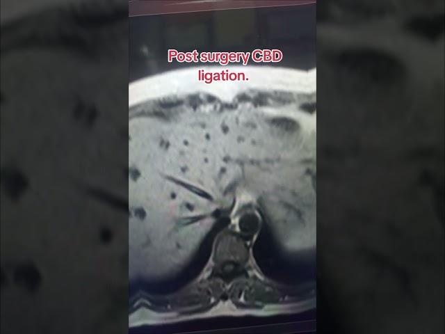 CBD Ligation post surgery