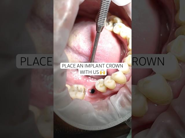 How it’s done: Placing an implant crown  #newsmile #dentalimplant #implant #compositeveneer